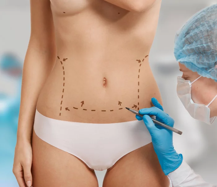 Abdominoplastia