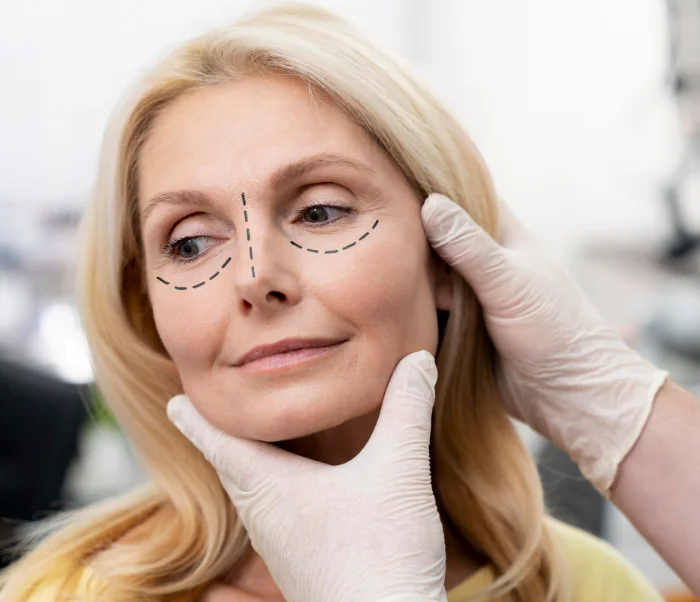 Blefaroplastia
