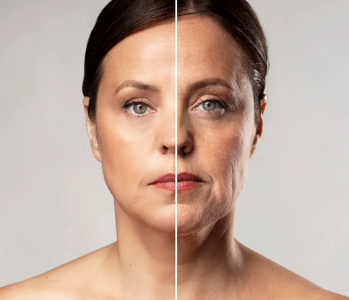 botox