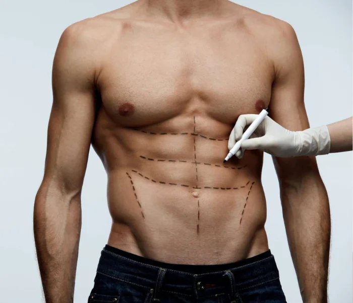 LIPOMARCACION ABDOMINAL